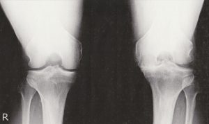 膝の写真20160719