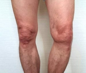 膝の写真20160722