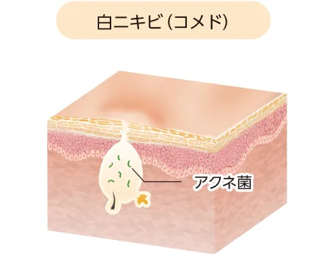 白ニキビ(コメド)