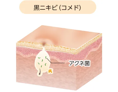 黒ニキビ(コメド)